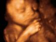 3D Fetal Ultrasound!