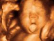 3D Fetal Ultrasound!